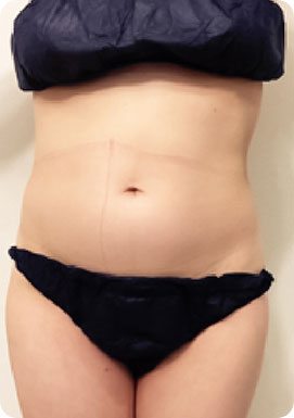 パワーレメディ Before／After 施術症例　40代　お腹20分　1回の施術