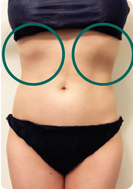 パワーレメディ Before／After 施術症例　40代　お腹20分　1回の施術