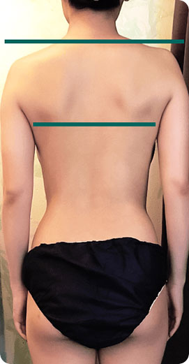 パワーレメディ Before／After 施術症例　30代　5回施術