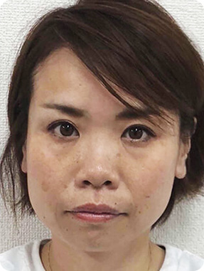 パワーレメディ 1回20分の施術　20代女性 短時間で小顔、長持ち