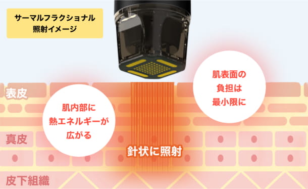 たるみ・ほうれい線等に効果的 サーマルフラクショナル
